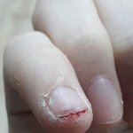 [댓글부탁해] 너네 <b>손톱</b> 이지경까지 아파본적 있냐