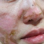 [방탈죄송] 얼굴관리시술받고 화상입었는데 신경쓰기싫다며 소송걸라네요...