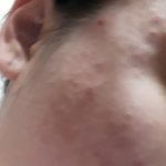[조언부탁해] 여드름 없애는 법 좀