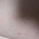 [<b>사진약</b>혐] ㄴㅏ 갑자기 다리에 반점?두드러기같은거났는데