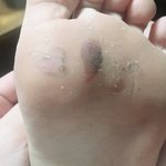 [혐주의] 혐주의야 발바닥에 <b>물집</b>에 피찼다는데 어떡해 혐주의