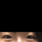 쌍수 <b>전후</b> 비교