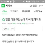 [댓글부탁해] 나 턱이 벌어지는데 어떡해?