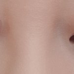 쌍수 절개 자국 없어질까?ㅜ ㅜ