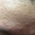 [조언부탁해] 피부때문에 진심으로 죽고싶어