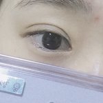 [조언부탁해] 앞트임 할까 말까 ??