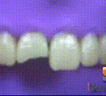 깨진 치아 <b>복원</b>하는 방법ㄷㄷㄷ