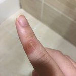 [조언부탁해] 이게 파상풍인지 <b>물집</b>인지 뭔지ㅜㅠㅠ(사진 ㅇ