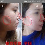 [댓글부탁해] <b>번장</b> 필러 잘 아는 사람..