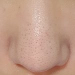 [조언부탁해] 사진혐)블랙<b>헤드</b> 어케없애 ㄹㅇ