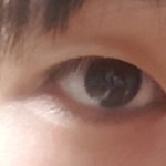 [드루와] 나 앞트임+쌍수하는데