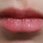 [댓글부탁해] 이거 헤르페스 <b>감염</b>인가요?