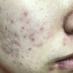 사진혐주의)나 여드름 <b>흉터</b> 제발 도와줘ㅠㅠ