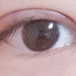 [ㅈㄱㄴ] 나 쌍수했는데 붓기가ㅠㅠ