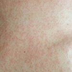 목욕탕에서 <b>세신</b>받고 전신에 피부염났습니다 (급해요)