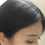 [댓글부탁해] 이마 지방이<b>식한</b>거 같나요??