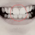 [댓글부탁해] 얘들아 <b>치아</b>교정 고민 좀 들어줘ㅠㅠ