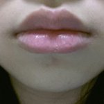 교정전후 입술<b>모양</b>차이
