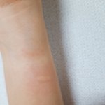 [조언부탁해] 나 <b>화상</b> 입은거 같은데 어떻게 해야해 ㅠㅠㅠㅠ
