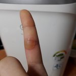 [댓글부탁해] __나 조카큰<b>물집</b>났는데 어카냐