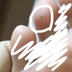 [댓글부탁해] <b>발가락</b>에 이거뭐야  ㅠㅠ?
