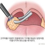 ⭐️2주의 기적⭐️ <b>편도</b>수술 후기(말 많음 주의)