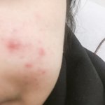 [댓글부탁해] 피부고민 어<b>카지</b>