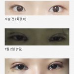 [조언부탁해] <b>쌍수</b> 했는데 붓기 많이 빠진 건지 좀 봐주라