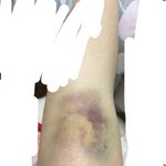 [조언부탁해] 나 다리에멍들었는데 이거 너무 <b>심각</b>한거아니야...?