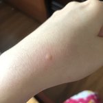 엥 나 모기 <b>물림</b>???