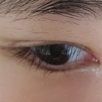 [댓글부탁해] 쌍수 <b>흉살</b> ㅠㅠ
