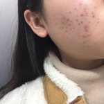 [댓글부탁해] 아진짜<b>피부</b>땜에돌아버리겠으 ..<b>사진</b> 혐 <b>주의</b> ㅠㅠ