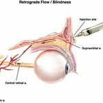 [충격] 필러 부작용 <b>실명</b>되는 이유ㄷㄷ