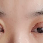 [이것좀봐줘] <b>쌍수</b> 절개하고 일주일하고 하루ㅠㅠ