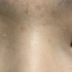 [댓글부탁해] 쌍수 잘된건지 좀 봐주랑 ㅜㅜ