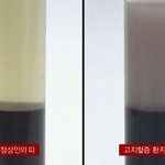 [충격] 정상<b>혈액</b>과 고지혈증 <b>혈액</b>.jpg