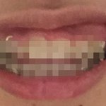 [드루와] 혐)웃을때 입비<b>대칭</b>인데 성형