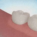 [모두드루와] 매복 사랑니 뽑는과정.<b>GIF</b>