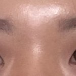 나 앞트임해야할까??급행 ㅠㅠㅠ