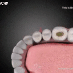 [모두드루와] 발전하고 있는 <b>충치</b> 치료