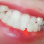 [사진ㅇ] 나 덧니 심한 거야?