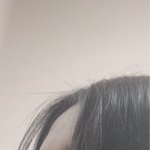 [댓글부탁해] 나 이마 <b>필러</b> 맞아야됨?