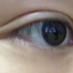 애들아 쌍수 <b>절개</b> 원래 붓기 늦게빠지니?ㅜㅜㅜㅜㅜㅜ