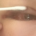 혐 주의))) 쌍수풀트임눈교 2일찬데 결막<b>부종</b> 어카냐