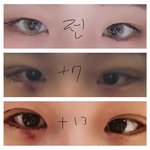 애들아 나 <b>쌍수</b>했는데 봐주라
