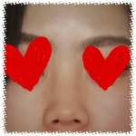 이사람 코필러<b>전후</b> 개오짐