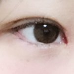 [댓글부탁해] 쌍수 절개 <b>눈</b>교 앞트임했는데 갈수록 <b>눈</b>이이상해져ㅠ