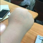 [댓글부탁해] 여드름 <b>패치</b> 붙이는 이유가 모야