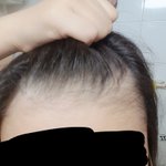 [이것좀봐줘] 엄마때문에 십대탈모왔네요
