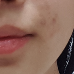 [댓글부탁해] 이거 <b>모낭염</b>이야??